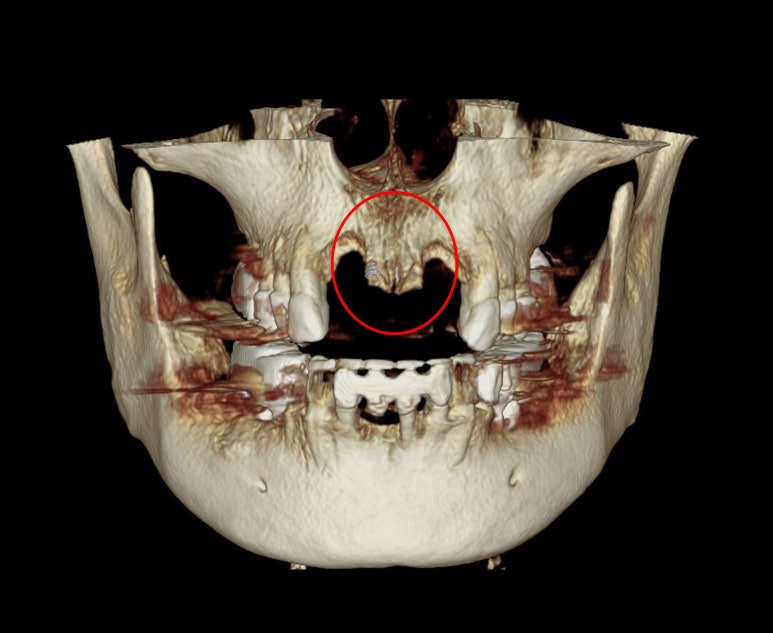 앞니가 풍치로 흔들거려요. 심한 치주염인데 임플란트 가능할까요? 치료과정/치료기간/비용/성공후기. 신금호역 치과 추천. 관련 이미지 11