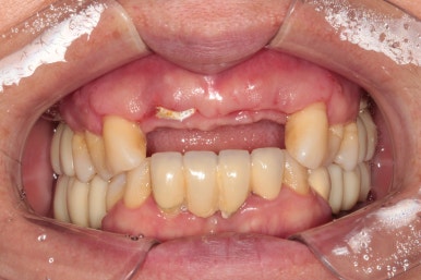 앞니가 풍치로 흔들거려요. 심한 치주염인데 임플란트 가능할까요? 치료과정/치료기간/비용/성공후기. 신금호역 치과 추천. 관련 이미지 22