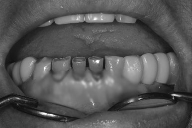 어금니 여러개가 없어요. 전체 임플란트와 앞니 크라운을 통한 완벽한 재건!! 치료과정/치료기간/비용/후기. 관련 이미지 15