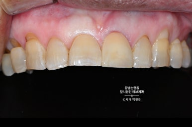 강남논현동치과 60대 치아부러짐 - 신경치료하고 기둥심고 앞니 크라운 잘하는곳! 가격/과정/후기/부작용. 관련 이미지 16