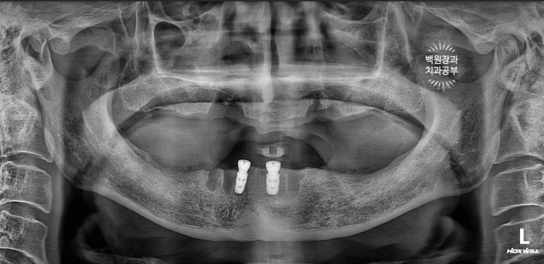 임플란트에서 고름이 나와요. 임플란트 주위염 그리고 재수술을 위한 준비. 치료과정/치료기간/비용/후기. 관련 이미지 7