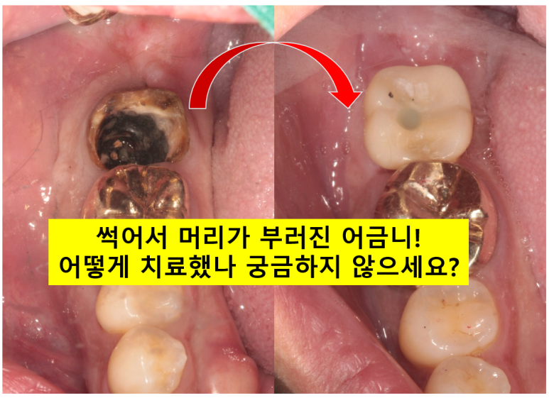 신경치료한 치아 부러짐! 뼈이식 하면서 임플란트 수술하는 과정/기간/비용. 관련 이미지 1