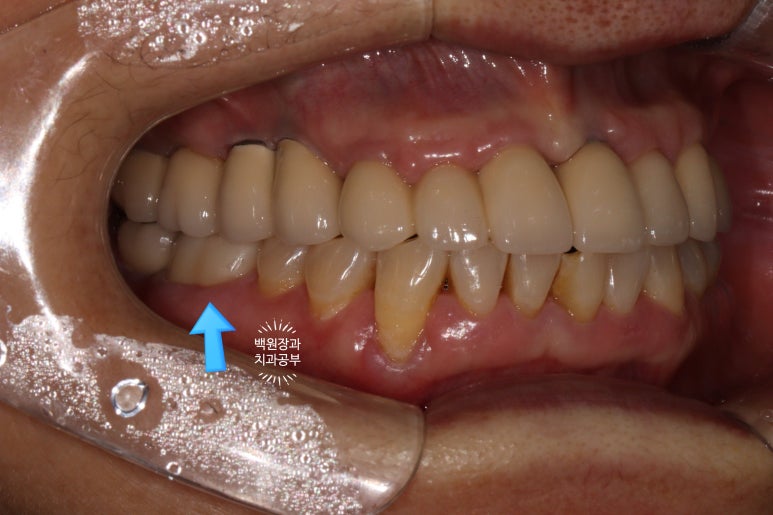 어금니 보철물이 떨어졌어요. 골드인레이 탈락 후 지르코니아 크라운으로 치료. 충치치료과정/치료기간/비용/후기. 관련 이미지 15
