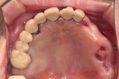 어금니 여러개가 없어요. 전체 임플란트와 앞니 크라운을 통한 완벽한 재건!! 치료과정/치료기간/비용/후기. 관련 이미지 5