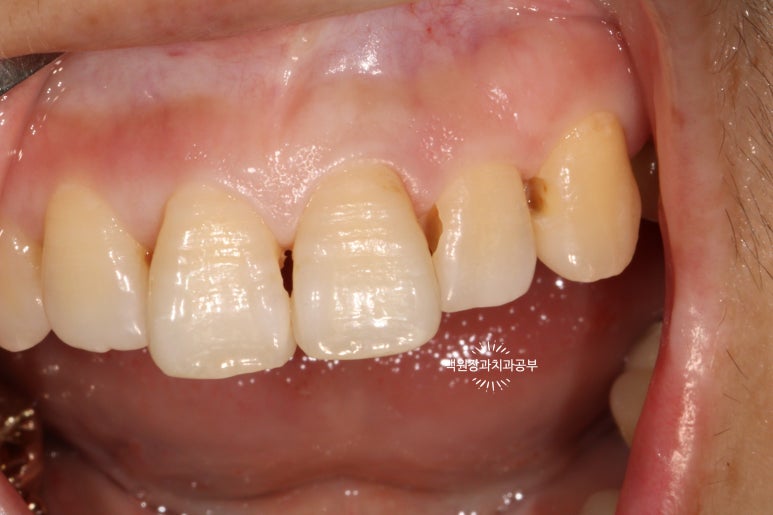 앞니레진치료 할 줄 모르는 치과의사는 없지만, 좋은 레진으로 치료하는 치과의사는 잘 없습니다. 관련 이미지 23
