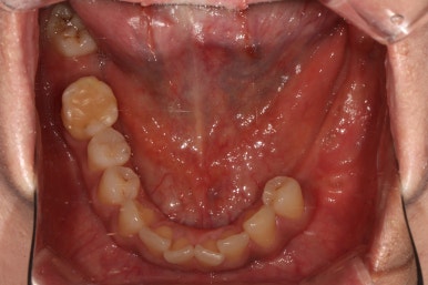 전세계 1위 스트라우만 임플란트를 사용한 어금니 기능회복과 앞니 지르코니아 크라운 증례. 관련 이미지 9