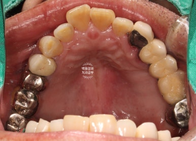 아래 어금니 임플란트 6개면 틀니를 안써도 됩니다.  치주염 전문 착한치과. 치료기간/임시치아과정/후기/비용. 관련 이미지 6