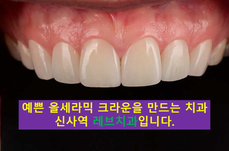 A European Patient at [Rev Dental Clinic] near Sinsa Station in Seoul Wanted Front Tooth Decay Treated with an EMAX All-Ceramic Crown. image 1