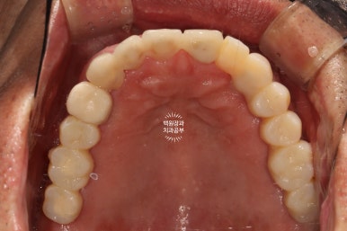 임플란트장인의 마음으로 8개월간 전체임플란트 완성. 치주과 전문의. 관련 이미지 23