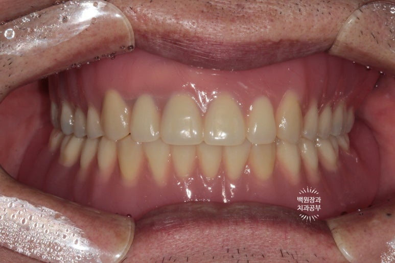 임플란트틀니 - 오버덴쳐. 오스템BA임플란트 이용한 최고의 가성비 치료. 치료과정/치료기간/비용/후기. 관련 이미지 16