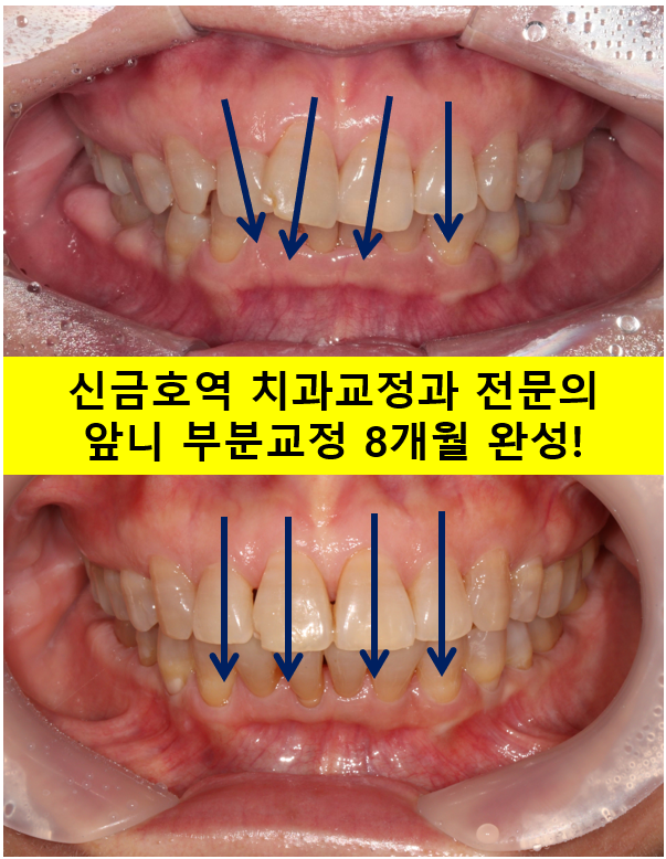 삐뚤어진 앞니를 8개월만에 가지런하게 만드는 50대 성인부분교정. 신사역 교정치과. 치료과정/기간/비용. 관련 이미지 1