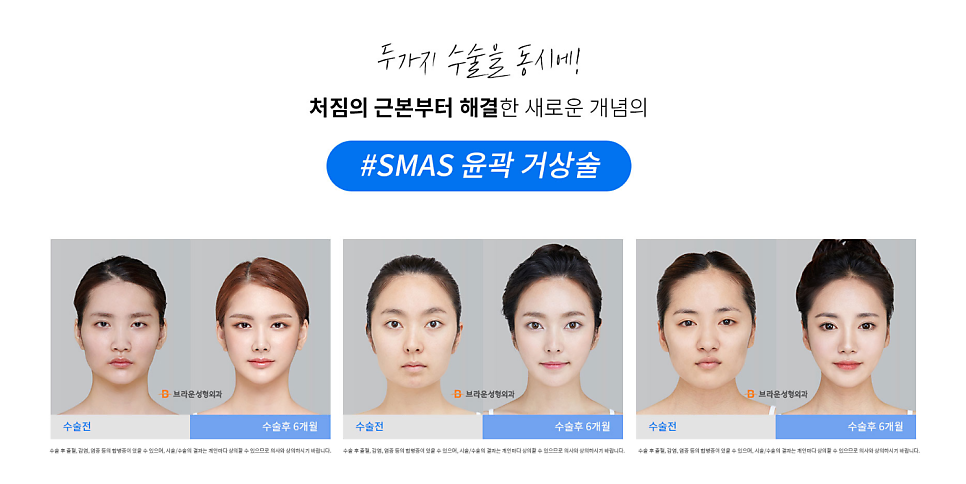 브라운성형외과 당기는 안면윤곽 :: 리프팅과 윤곽을 동시에! 관련 이미지 3