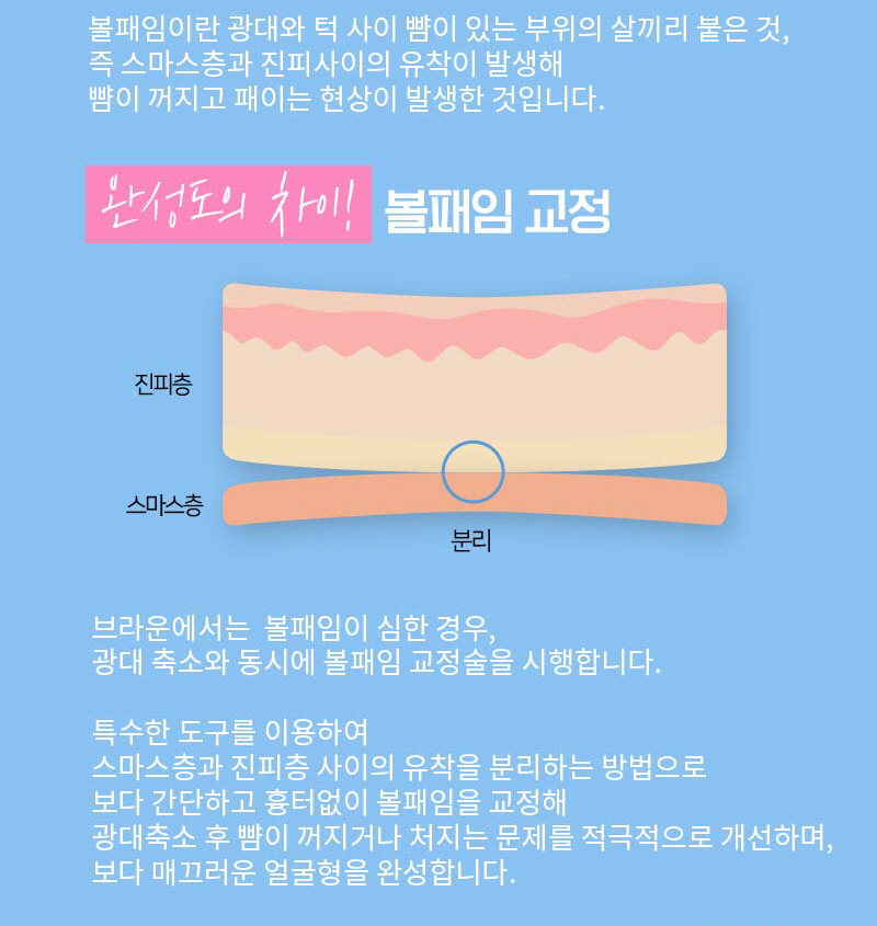 브라운성형외과 리프팅 3D 광대회전술 관련 이미지 4