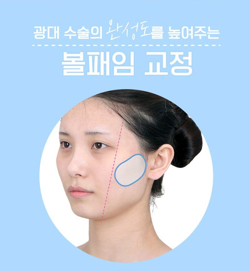 리프팅 3D 광대회전술 볼처짐 걱정 없이 광대 축소하자 :: 브라운성형외과 관련 이미지 3
