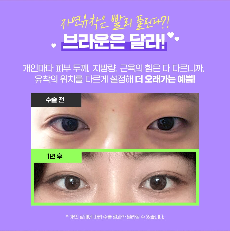 브라운 𝐄𝐕𝐄𝐍𝐓 :: 자연스럽게 오래가는 예쁨! 10매몰눈성형 관련 이미지 5