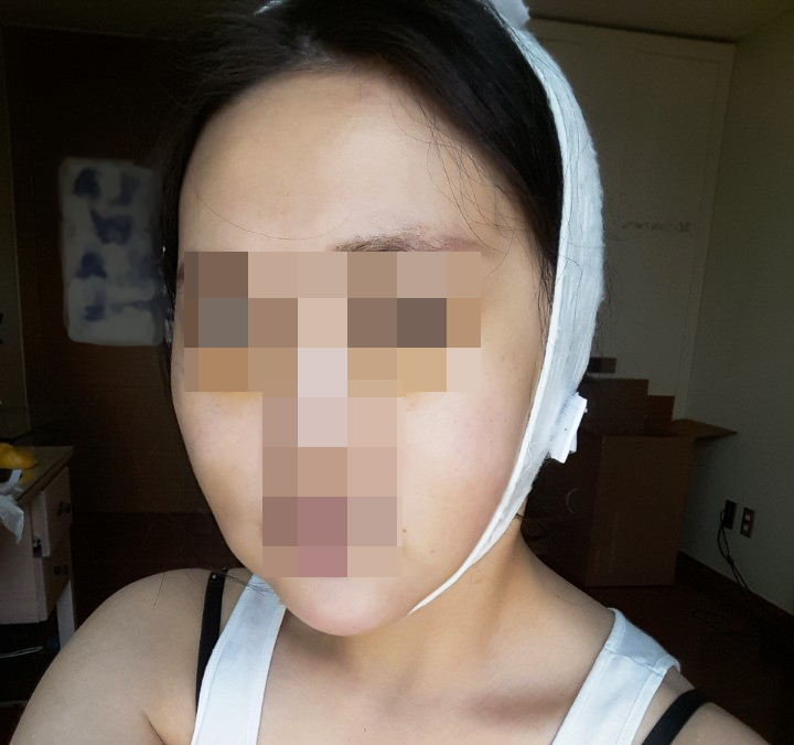 안면윤곽술 후 거상술 괜찮은가요? 관련 이미지 8