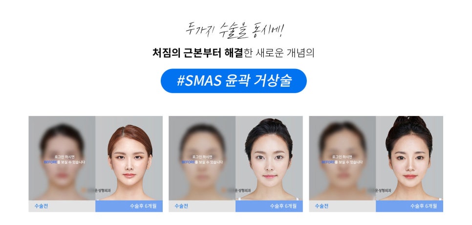 브라운성형외과 당기는 안면윤곽 :: 리프팅과 윤곽을 동시에 관련 이미지 3