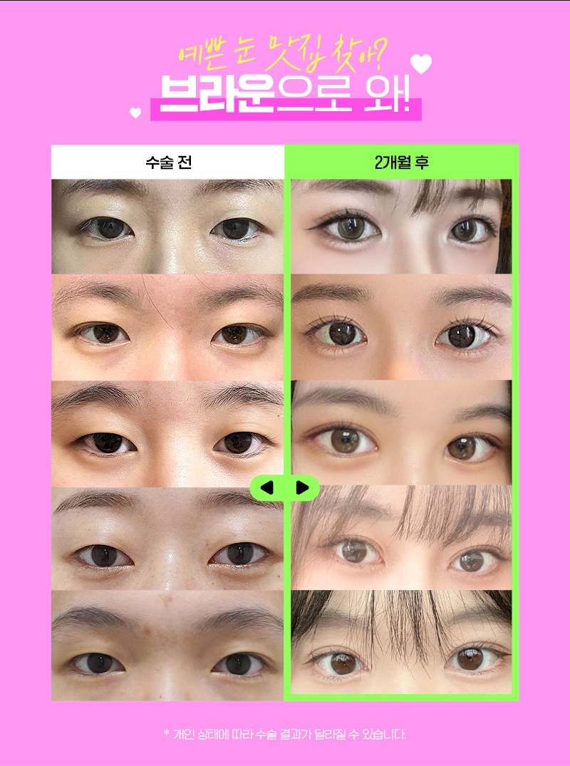 브라운 𝐄𝐕𝐄𝐍𝐓 :: 자연스럽게 오래가는 예쁨! 10매몰눈성형 관련 이미지 2