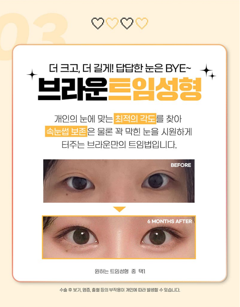 브라운성형외과 올인원 눈성형 :: 오직 나를 위한 착붙라인! 관련 이미지 6