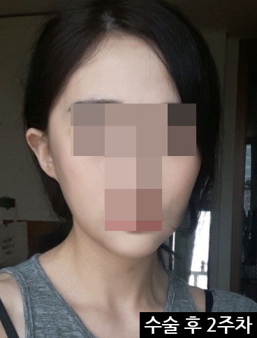 안면윤곽술 후 거상술 괜찮은가요? 관련 이미지 6