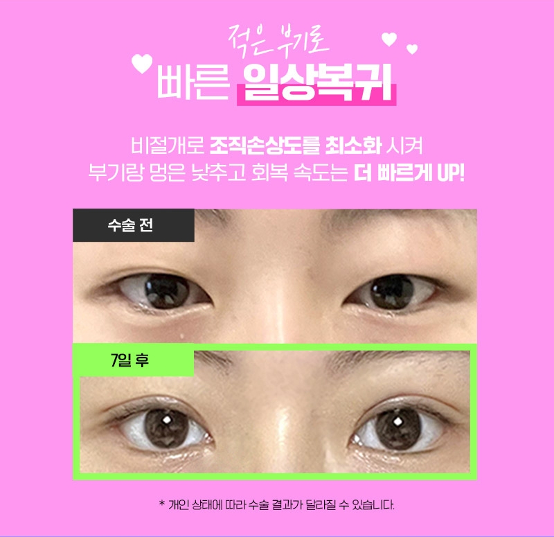 브라운 𝐄𝐕𝐄𝐍𝐓 :: 자연스럽게 오래가는 예쁨! 10매몰눈성형 관련 이미지 4