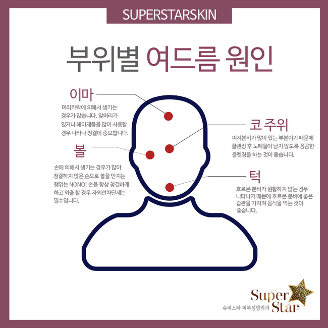 [구로피부과전문의]슈퍼스타피부과가 알려주는 피부상식! 여드름, 이것만은 알고있자! 관련 이미지 2