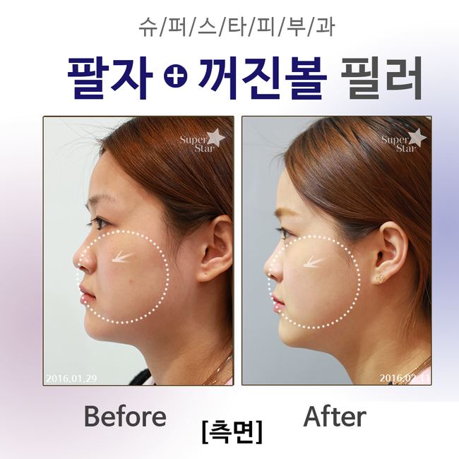 [구로피부과전문의] 전문의가 직접 시술하는 슈퍼스타 쁘띠필러! 간단하고 빠른 효과를 보고 싶으시다면 주목! 관련 이미지 4