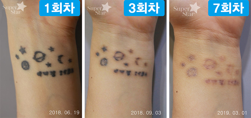 구로디지털단지역피부과 문신제거 정보드려요 관련 이미지 6
