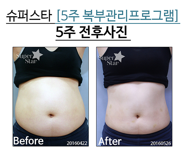 [구로비만클리닉] 슈퍼스타 5주 복부관리프로그램~ 6kg감량 성공스토리!! 관련 이미지 8