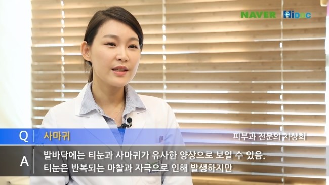 티눈, 사마귀 어떻게 치료해야 할까요? 관련 이미지 2