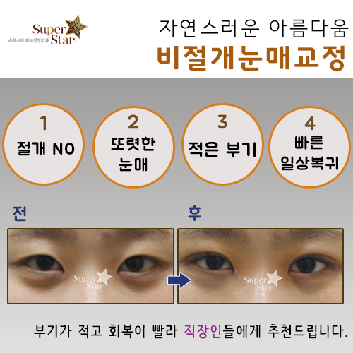 [구로눈성형]구로눈성형잘하는 슈퍼스타피부성형외과~!! 직장인들에게 추천드리는 빠른복귀눈성형 소개해드려요~ 관련 이미지 2