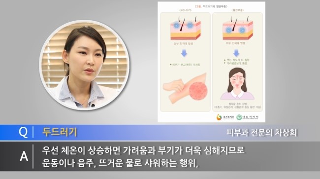 두드러기 원인과 치료방법 알아볼게요!! 관련 이미지 5