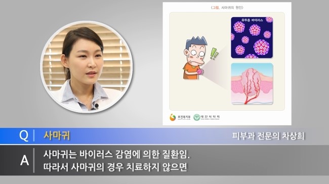 티눈, 사마귀 어떻게 치료해야 할까요? 관련 이미지 4
