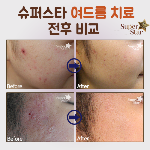 [구로피부과전문의]슈퍼스타피부과 여드름치료 소개해드려요~피부과전문의가 직접 시술하는 여드름 치료 관리! 관련 이미지 4