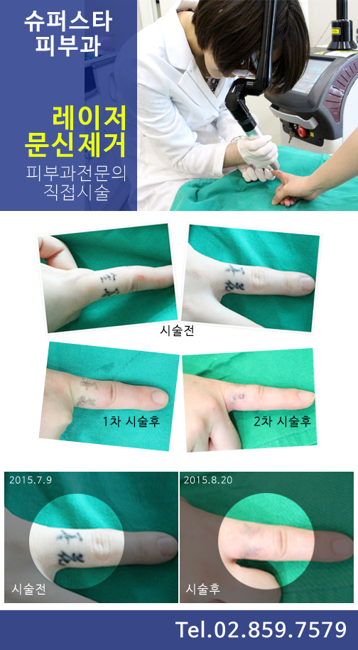 [구로피부과전문의] 구로슈퍼스타피부과 문신제거~피부과전문의가 직접시술하는 안전하고 꼼꼼한 시술!! 관련 이미지 5