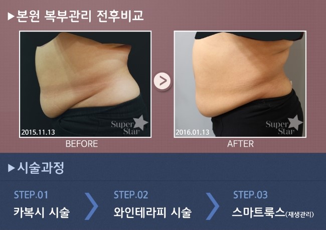 [구로피부과전문의]슈퍼스타피부과 와인테라피 비만관리 EVENT! 공개합니다~ 옷 얇아지기 전에 미리준비하세요! 관련 이미지 2