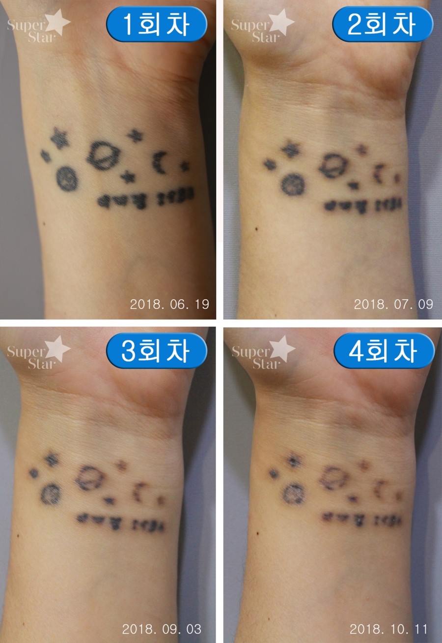 구로디지털단지피부과 피코플러스 문신제거 관련 이미지 1