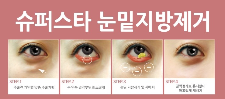 [구로성형]슈퍼스타의 눈밑지방제거!지긋지긋 팬더눈은 이제 벗어나세요~ 관련 이미지 1