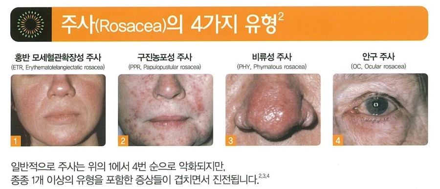 [구로피부과전문의]피부과 전문의 Dr.김민호원장님이 알려주는 피부질환 이야기. 01.주사이야기(수란트라) 관련 이미지 5