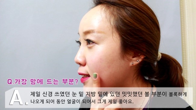 [구로성형]눈밑지방제거+얼굴지방이식=슈퍼리턴즈지방이식! 쏘다미의 수술후 한달! 관련 이미지 8