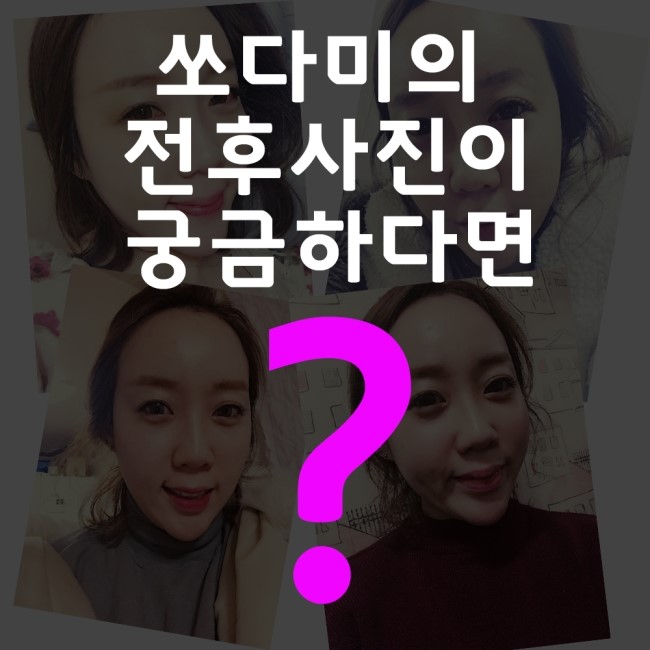 [구로눈성형]슈퍼스타 쏘다미의 동안얼굴 프로젝트~!!제 1편 준비했답니다!! 수술 전 소다미의 심정! 리얼하게 보여드려요~ 관련 이미지 8
