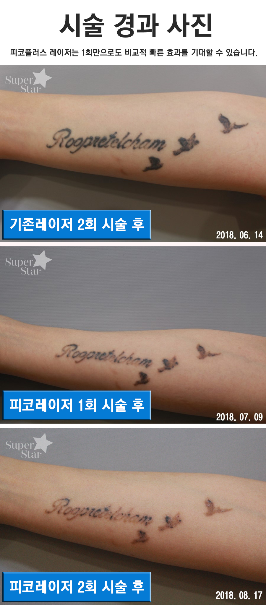 구로디지털단지역피부과 문신제거 2차후 경과 관련 이미지 1