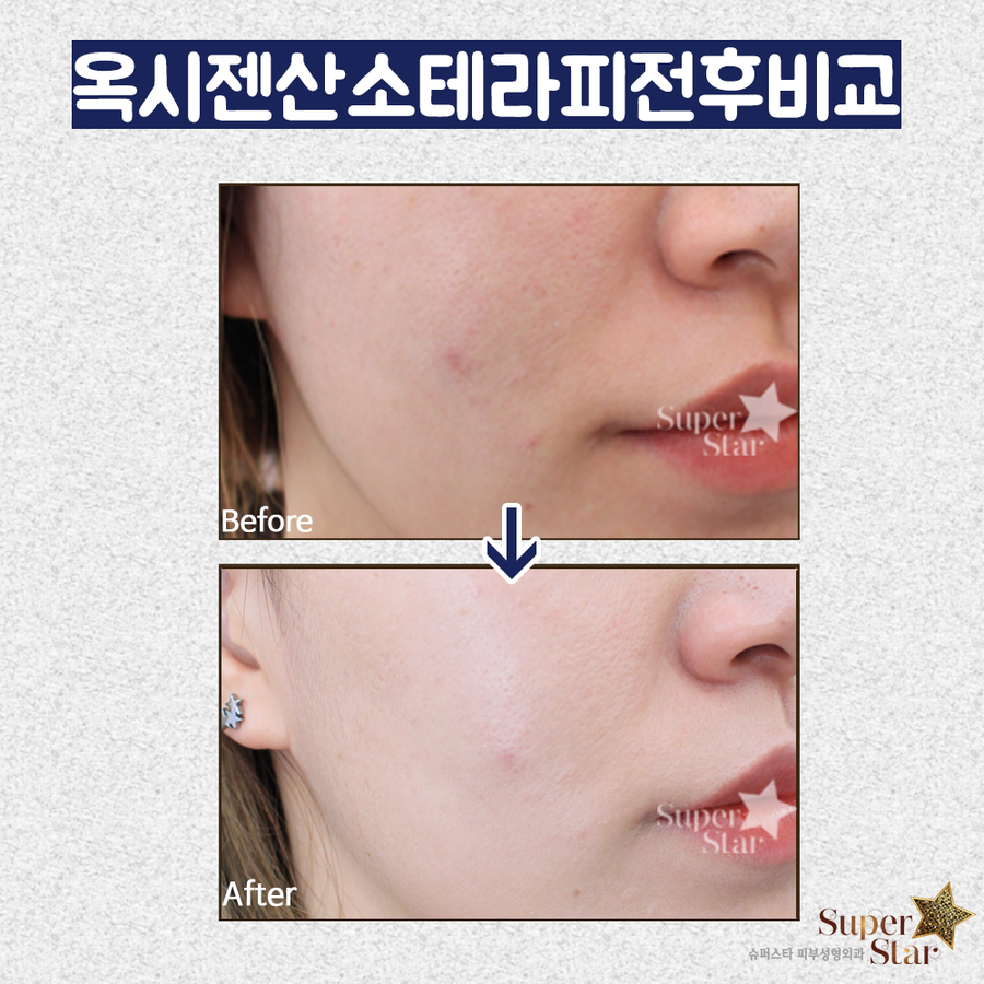 [구로피부과]색소질환과 여드름질환 한번에 잡자~피부를 순수산소로 깨끗하게 케어해요~슈퍼스타피부과 옥시젠산소테라피!! 관련 이미지 4