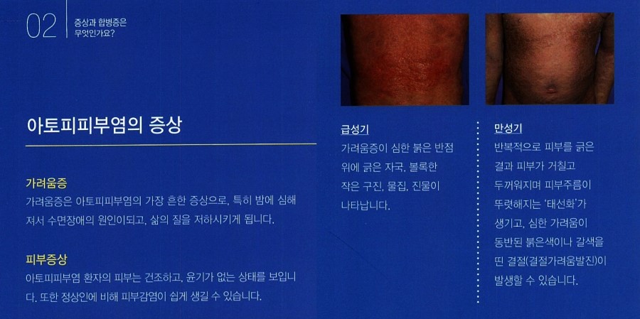 [구로피부과전문의]슈퍼스타피부과에서 알려주는 피부질환 이야기. 아토피 피부염-2 관련 이미지 4