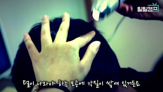 [구로탈모] 구로 슈퍼스타피부과의 탈모 프로젝트 탈탈캠프 ! 관련 이미지 5