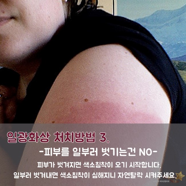[구로피부과전문의] 슈퍼스타피부과가 알려주는 일광화상 처치방법~! 관련 이미지 5