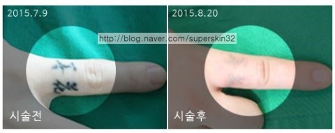 [구로피부과전문의] 구로슈퍼스타피부과 문신제거~피부과전문의가 직접시술하는 안전하고 꼼꼼한 시술!! 관련 이미지 3