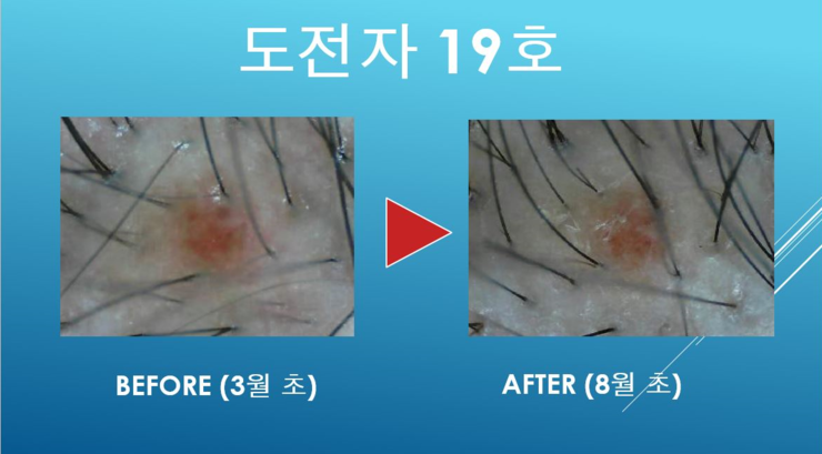 [구로디지털단지 탈모]구로 슈퍼스타피부과 탈모 프로그램 탈탈캠프!마지막 촬영기~~~! 관련 이미지 2