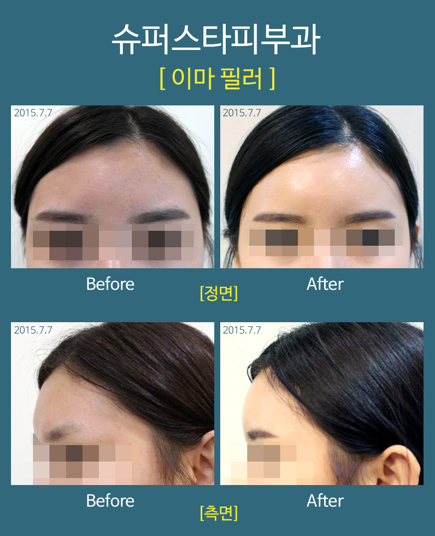 [구로피부과]구로디지털단지 슈퍼스타피부과 필러시술에 주목하세요!!~ 관련 이미지 1