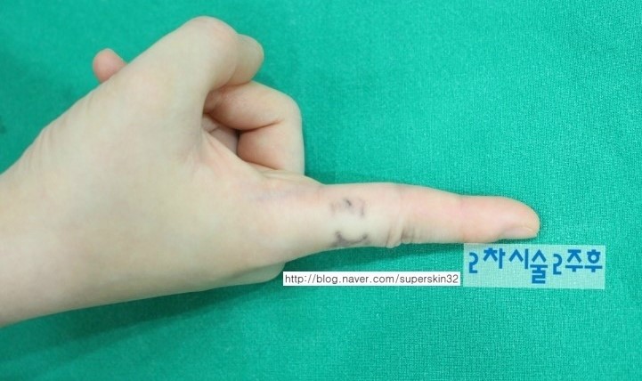 [구로문신제거]슈퍼스타피부과 손가락문신제거 3차시술 대.공.개!!~~~ 관련 이미지 2